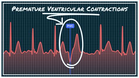 beta blockers and exercise|Premature ventricular contractions (PVCs) .